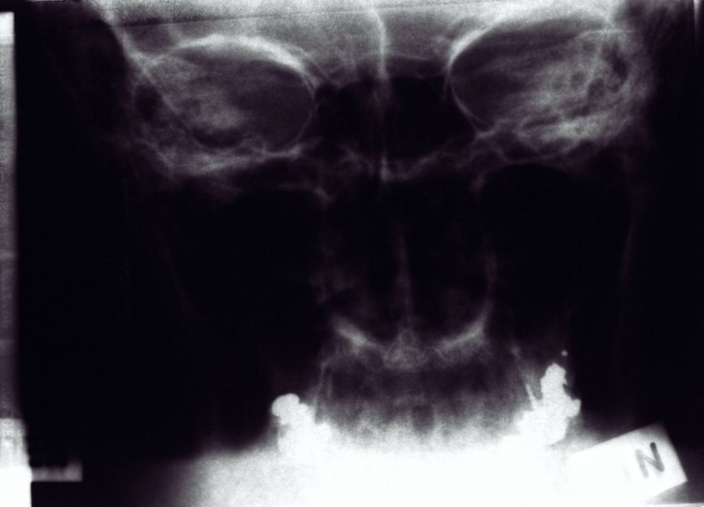 Photo Meniscus repair Poland