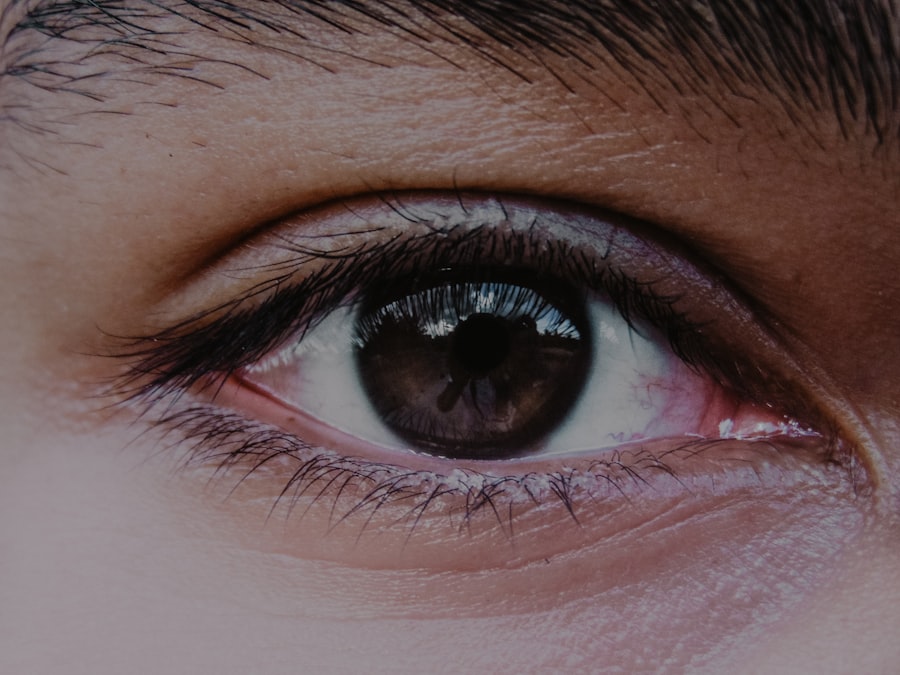 Blepharoplasty